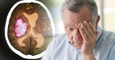 السكتة الدماغية الصباحية.. لماذا تكثر بين السادسة صباحاً والظهيرة؟